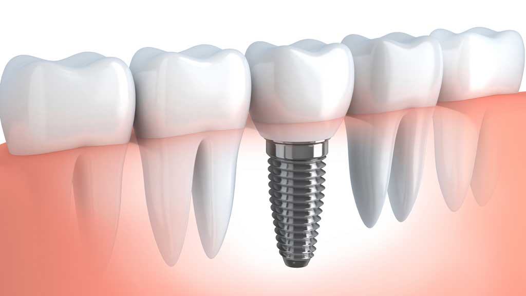 The Point Dental Implants
